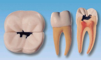 右側(cè)第一顆磨牙蛀牙模型YR-L1002